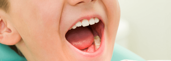 коронки на молочные зубы фото